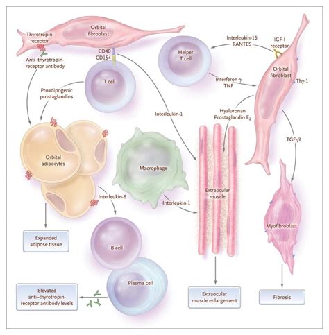 Graves Ophthalmopathy Nejm