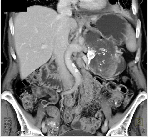 Spen Tumor Tail Of The Pancreas Pancreas Case Studies Ctisus Ct