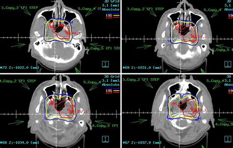 Nasopharyngeal Carcinoma Treated With Reduced Volume Intensity