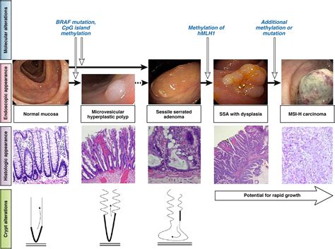 Endoscopic And Histologic Features Of Sessile Serrated Polyps And My