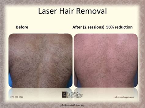 Laser Hair Removal Newnan Permanent Hair Reduction Peachtree City