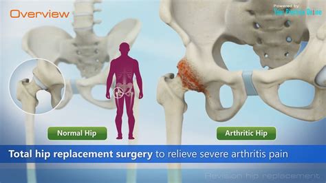 Revision Hip Replacement Video Hip Orthopaedics Videos Ypo Patient
