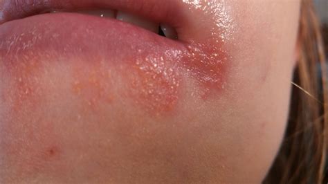 Redness Around Lips Redness Lips Eczema