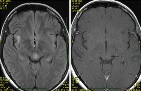 Mri At Time Of Neurological Onset 2 2005 Notes The Infiltrative