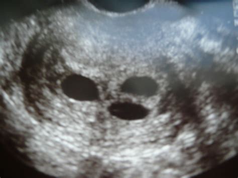 Triplet Pregnancy Ultrasound