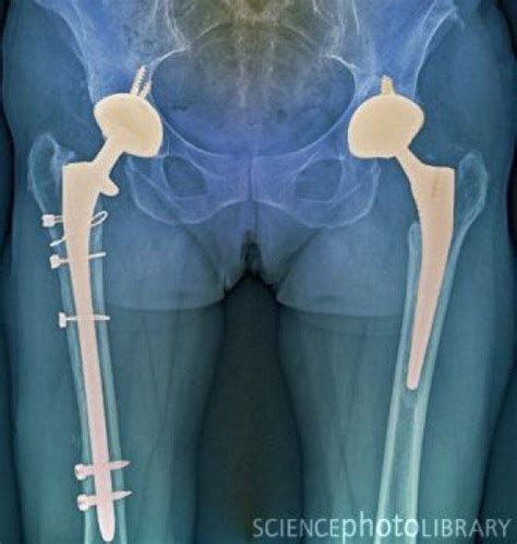 Double Hip Replacement Post Op X Ray Avascular Necrosis Avascular Hip Replacement