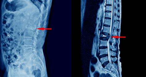 What Is A Herniated Disc Mri And When Do You Need It Dr Kevin Pauza