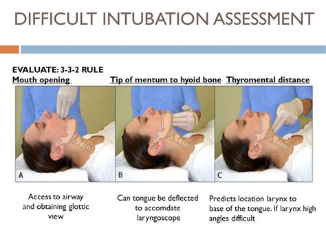 The Difficult Airway Management In Adult Critical Care 5 May 2014 J