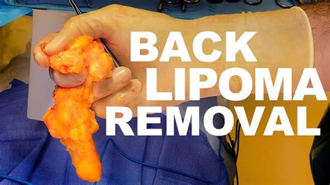 How Do They Surgically Remove A Lipoma