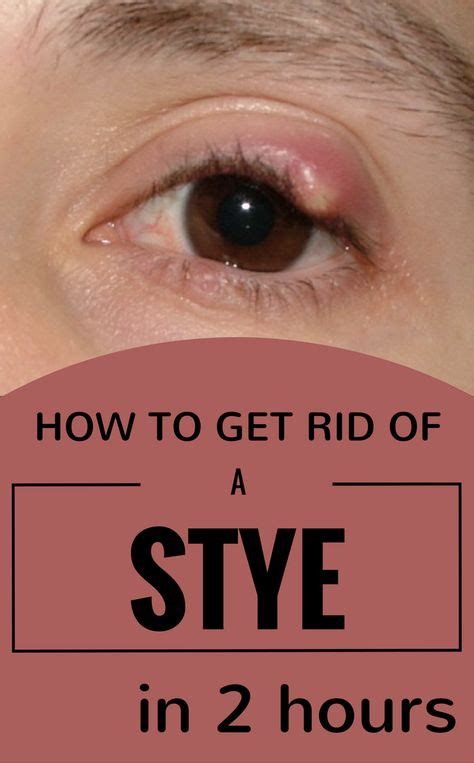 How To Get Rid Of A Stye In 2 Hours Eye Stye