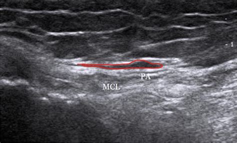 Pes Anserine Tendinopathybursitis Ultrasound Guided Injections Porn