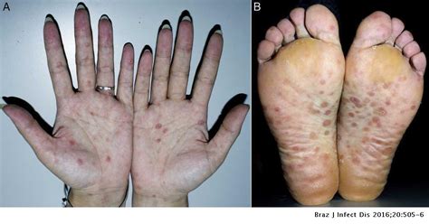 Arthralgia And Scaly Rashes Over The Palms And The Soles The