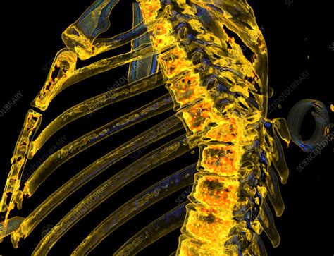 Thoracic Spine Fracture Ct Scan Stock Image C0582866 Science