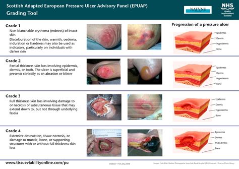 Ulcer Classification Scottish Adapted European Pressure Ulcer