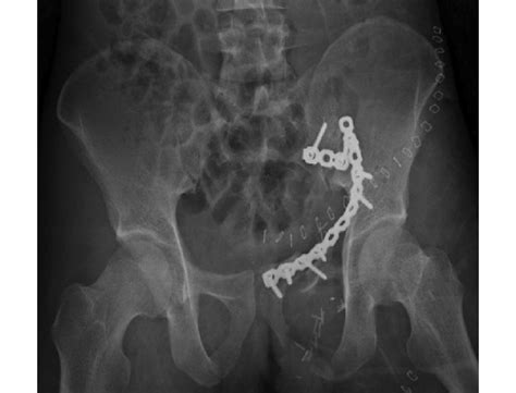 d pelvic radiograph following open reduction and ring and sacroilliac download scientific