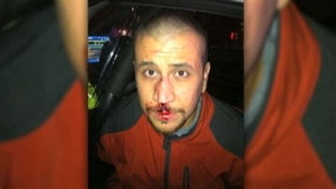 George Zimmermans Lawyers Release Bloody Color Photo Video Abc News