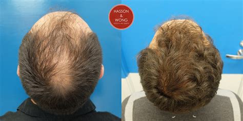 Hair Solutions Hasson And Wong Clinic Sessions 1 Grafts Implanted