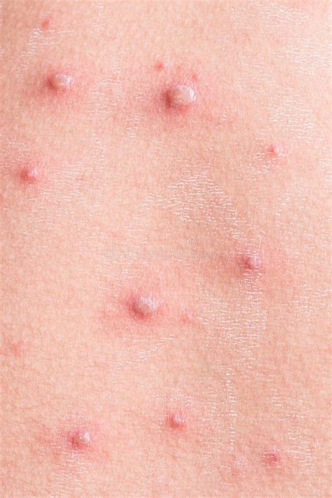 Chicken Pox Rash Stock Photo Image Of Middle Airborne 103118096