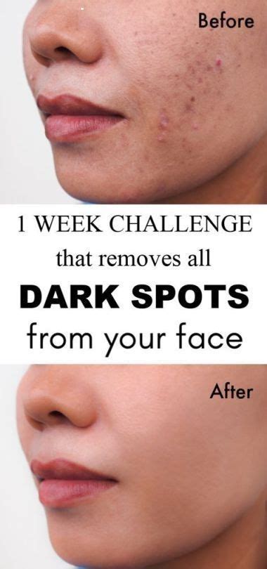 1 Week Challenge That Remove All Dark Marks Spots From Your Face Anti