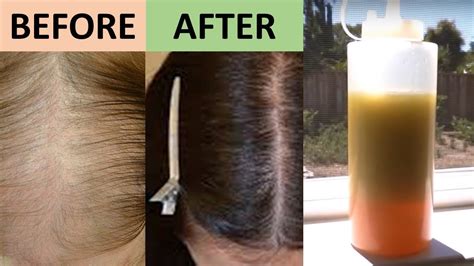 7 Day Hair Growth Miracle Treatment That Promotes Hair Growth From The