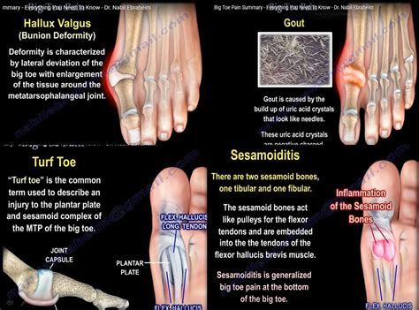 Differential Diagnosis Of Big Toe Pain —