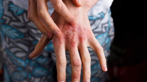 √1000以上 Eczema Rash On Wrist 329558 Contact Dermatitis Rash On Wrist