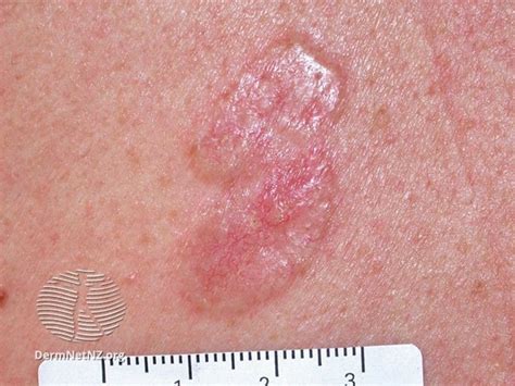 Red Scaly Rash Heres Why You Need A Dermatologist To