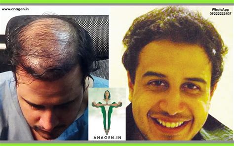 Anagen Hair Transplant Clinic Mumbai In Mumbai India Read 18 Reviews