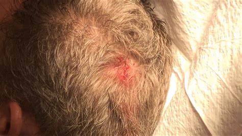 Scalp Cyst Removal 20180226 Youtube