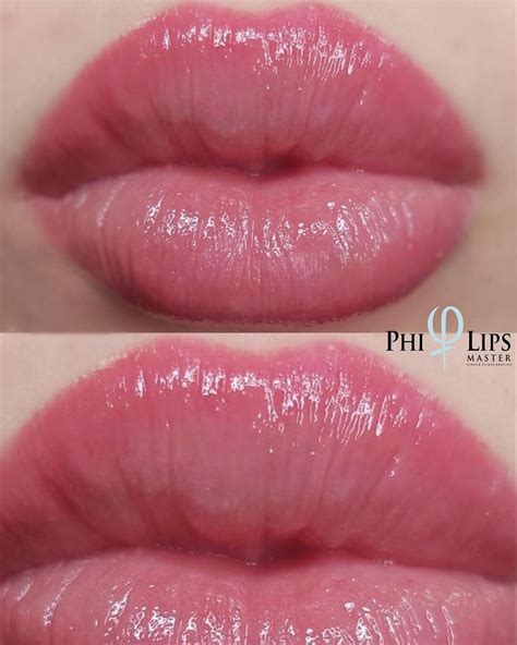 Kerstinellmerthorsten Kreiling On Instagram “phi Lips 👄 Healed Result