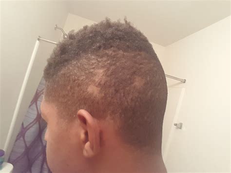 Random Bald Spots On Side Of Head 19 What Could It Be Is It
