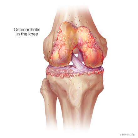 Knee Arthritis Overview Mayo Clinic Orthopedics Sports Medicine