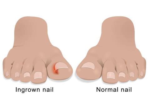 What To Do For Ingrown Nail Home Interior Design