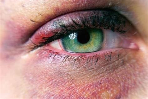 The Causes And Treatment Of Black Eye The Eye News