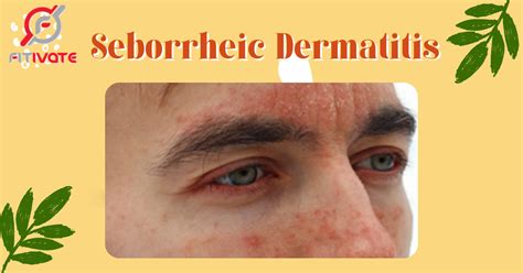 Seborrheic Dermatitis Treatments That Work