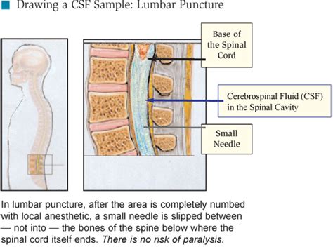 Lumbar Puncture Lp Crashing Patient