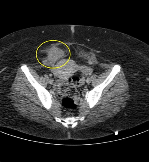 Endometriosis Ct C 41 Year Old Woman With Abdominal Wall