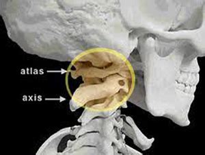 Assessment of traumatic brain injury assessment. Protect the "Upper Cervical Complex" with the Hulk Up ...