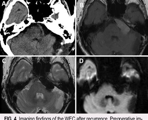 Figure 1 From White Epidermoid Cyst Transformation After Stereotactic