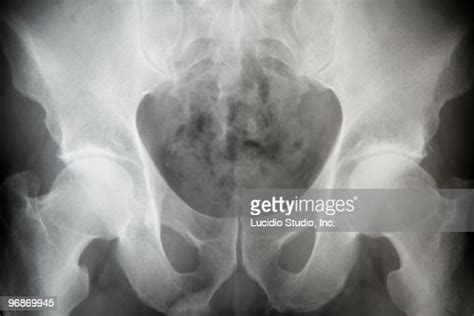 Male Pelvic Xray High Res Stock Photo Getty Images