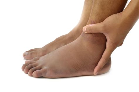 Fort Worth Foot Swelling Treatment Fort Worth Foot And Ankle