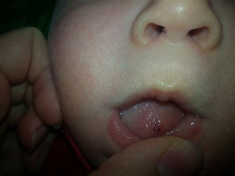 Dark Spot On Los Tongue Pip — The Bump