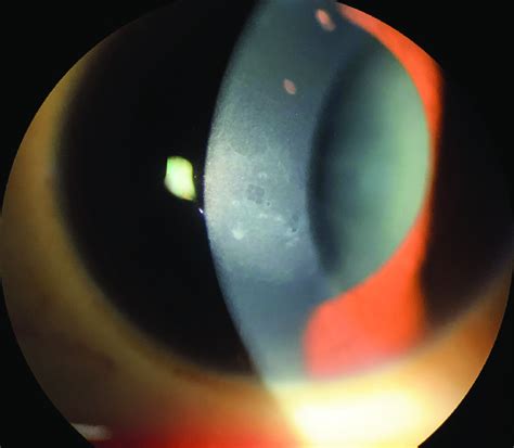 Slit Lamp Photograph Of Epithelial Basement Membrane Dystrophy This