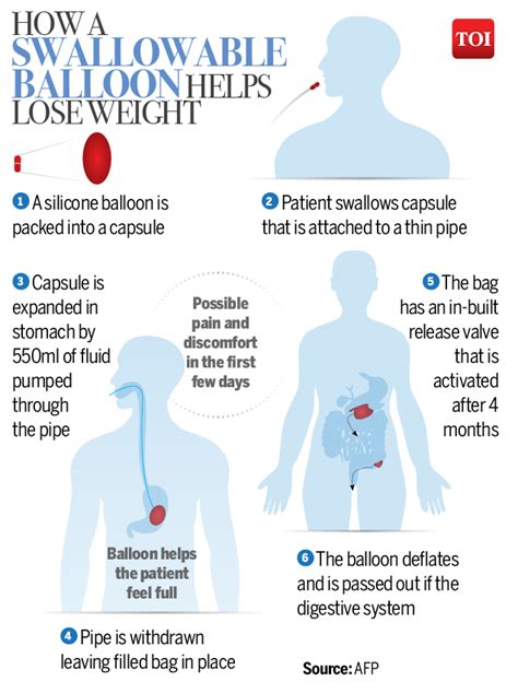 Infographic New Swallowable Balloon Could Help Weight Loss Times Of