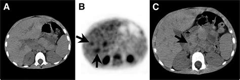 18f Fdg Petct Imaging Of Hodgkin Lymphoma In A Child With Common