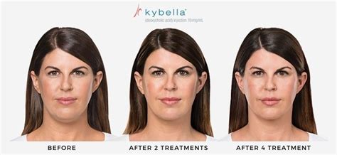 Kybella Before And After Real Patient Results In Salt Lake City