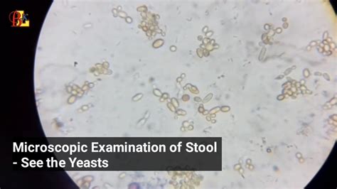 Microscopic Examination Of Stool See The Yeasts Youtube