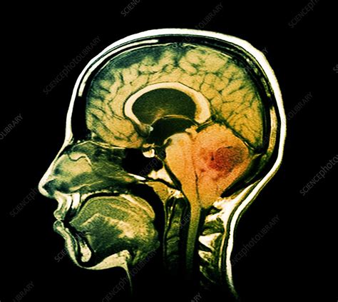 Brain Tumour Mri Scan Stock Image C0152683 Science Photo Library