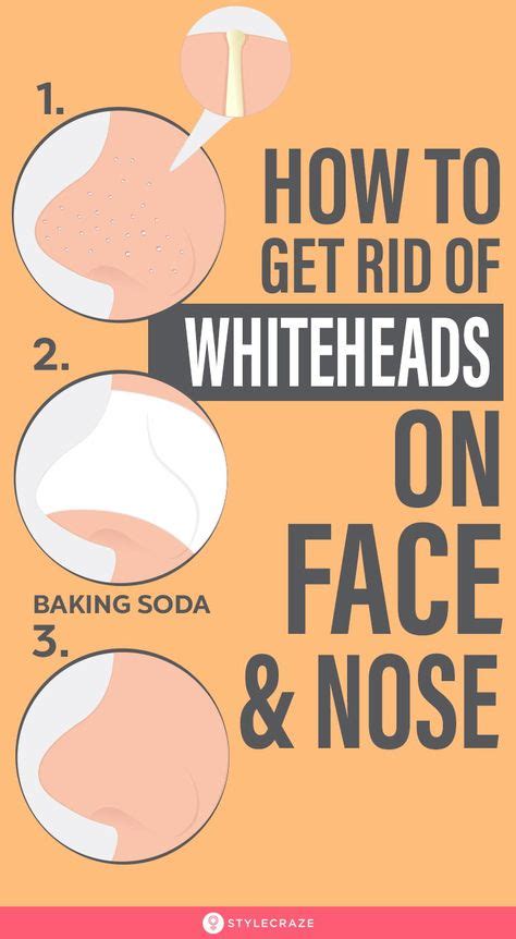 25 Best Remedies To Get Rid Of Whiteheads On Face And Nose Remedies