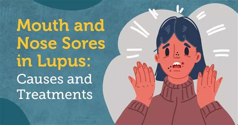 Mouth And Nose Sores In Lupus Causes And Treatments Mylupusteam
